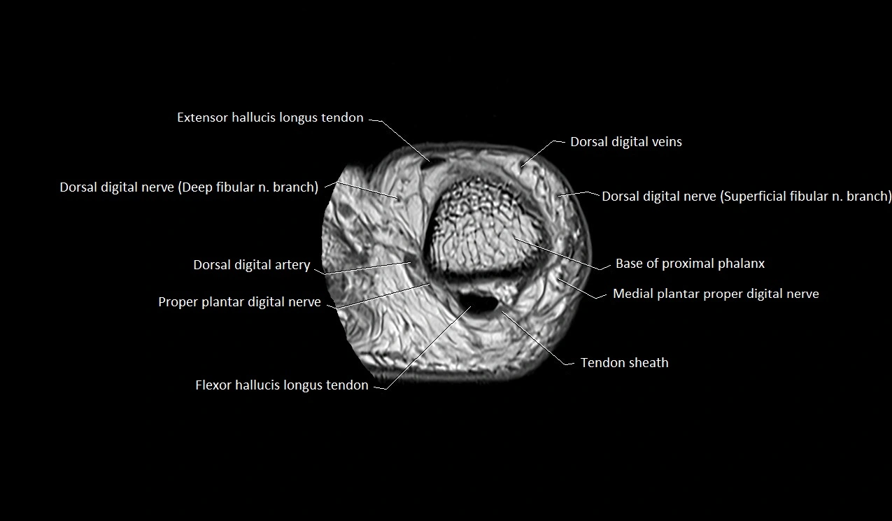 Great toe (hallux) axial microanatomy 3T MRI image 20.webp